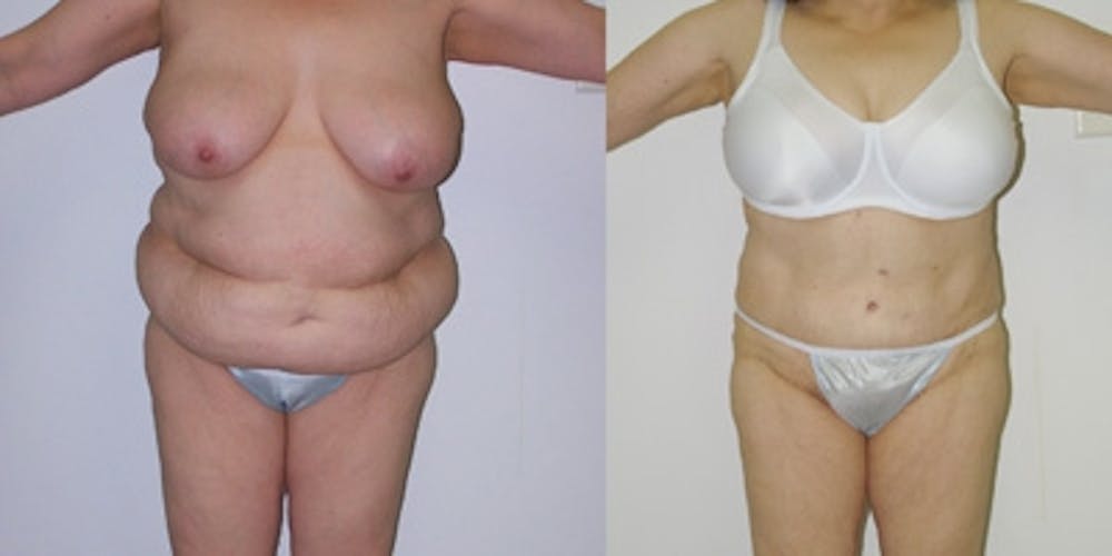 Liposuction Before & After Gallery - Patient 860747 - Image 1