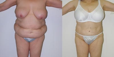 Liposuction Before & After Gallery - Patient 4567000 - Image 1