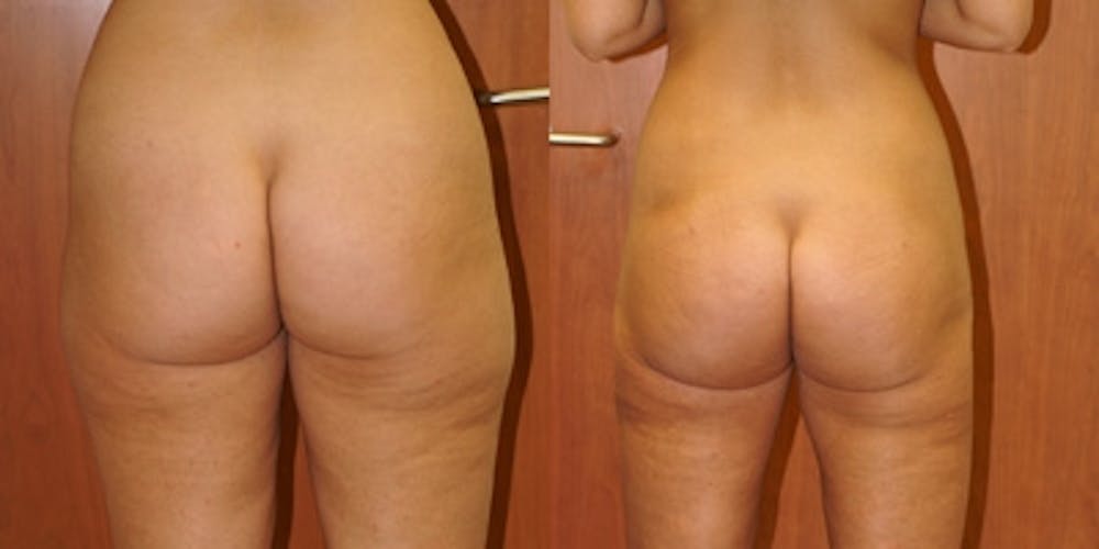 Liposuction Before & After Gallery - Patient 287731 - Image 1