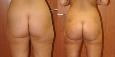 Liposuction Before & After Gallery - Patient 4567001 - Image 1