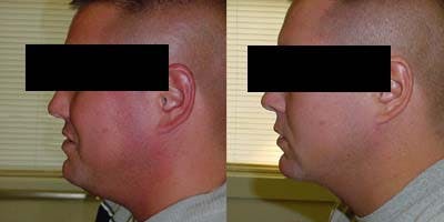 Liposuction Before & After Gallery - Patient 4567002 - Image 1