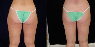 Liposuction Before & After Gallery - Patient 310414 - Image 1
