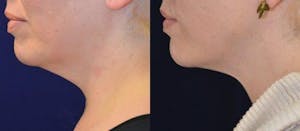 Neck Liposuction