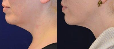Liposuction Before & After Gallery - Patient 366794 - Image 1