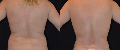 Liposuction Before & After Gallery - Patient 4567005 - Image 1