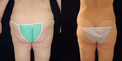 Buttock Lifts Before & After Gallery - Patient 4416058 - Image 1