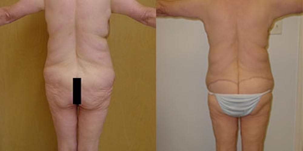 Buttock Lifts Before & After Gallery - Patient 4567026 - Image 1