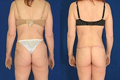 Buttock Lifts Before & After Gallery - Patient 4567027 - Image 1