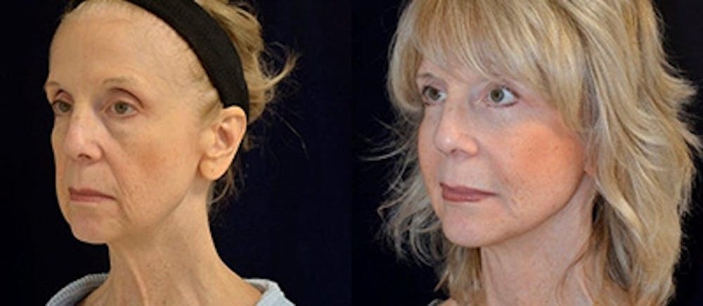 Brow Lifts Before & After Gallery - Patient 4567050 - Image 1