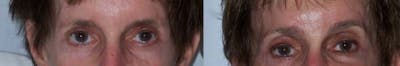 Brow Lifts Before & After Gallery - Patient 4567052 - Image 1