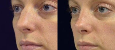 Rhinoplasty Before & After Gallery - Patient 4567056 - Image 1