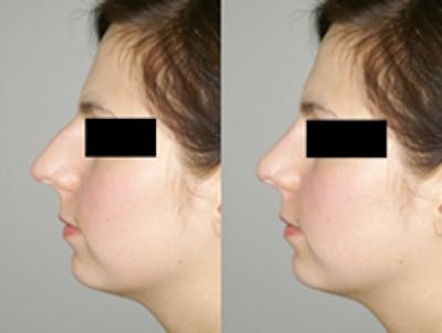 Rhinoplasty Before & After Gallery - Patient 4567057 - Image 1
