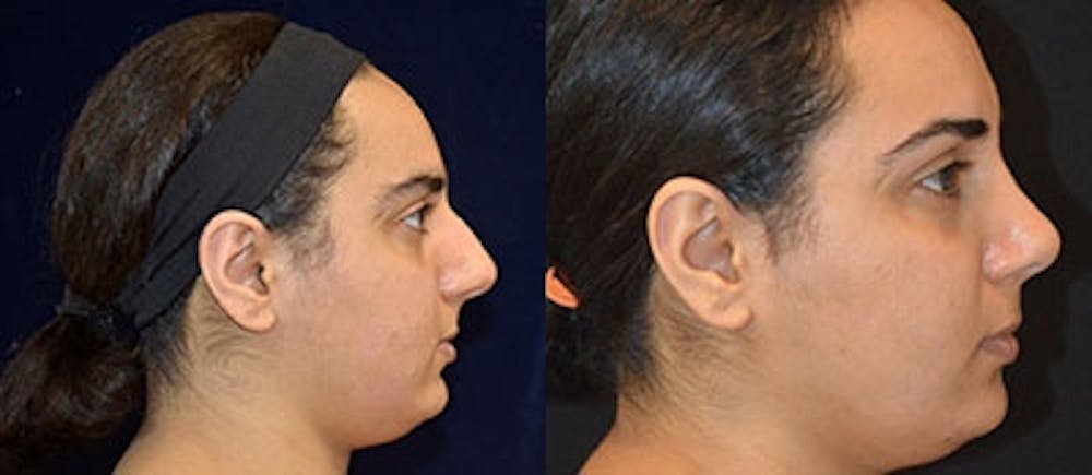 Rhinoplasty Before & After Gallery - Patient 4567058 - Image 1