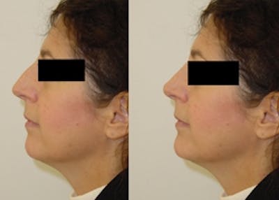 Rhinoplasty Before & After Gallery - Patient 4567059 - Image 1