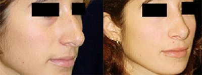 Rhinoplasty Before & After Gallery - Patient 4567060 - Image 1
