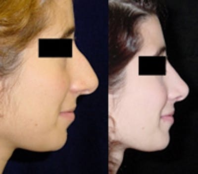 Rhinoplasty Before & After Gallery - Patient 4567061 - Image 1