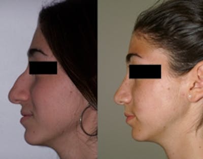 Rhinoplasty Before & After Gallery - Patient 4567062 - Image 1