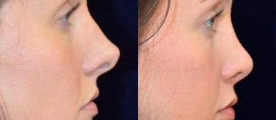 Rhinoplasty Before & After Gallery - Patient 4567063 - Image 1