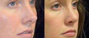 Rhinoplasty