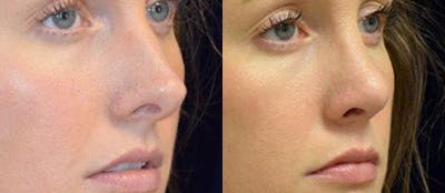 Rhinoplasty Before & After Gallery - Patient 4567064 - Image 1