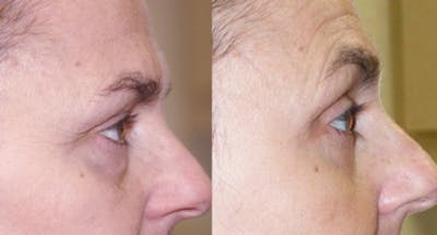 Blepharoplasty Before & After Gallery - Patient 168157 - Image 1