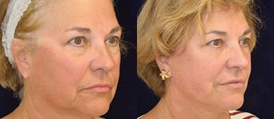 Blepharoplasty Before & After Gallery - Patient 301656 - Image 1