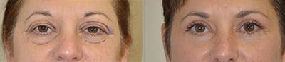 Blepharoplasty Before & After Gallery - Patient 399730 - Image 1
