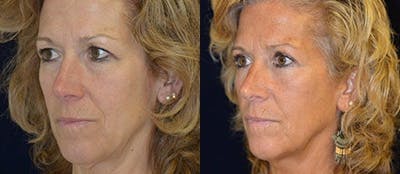 Blepharoplasty Before & After Gallery - Patient 189491 - Image 1
