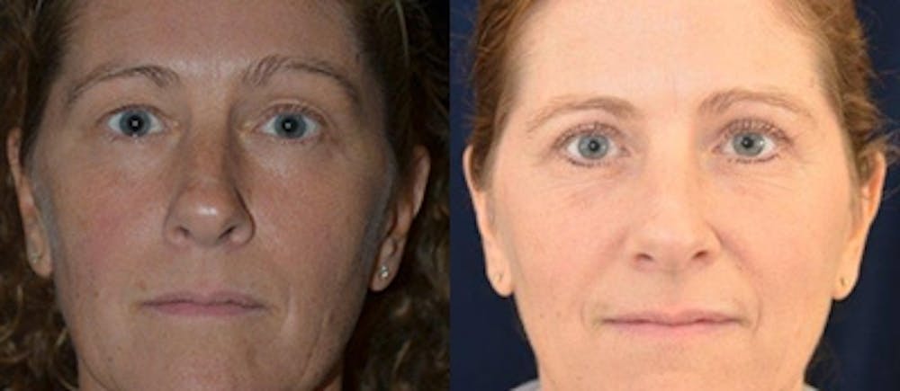 Blepharoplasty Before & After Gallery - Patient 168963 - Image 1