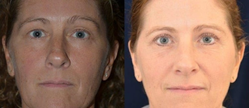 Blepharoplasty Before & After Gallery - Patient 4567076 - Image 1