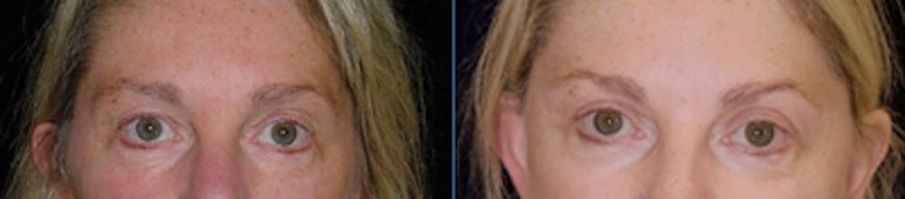 Blepharoplasty Before & After Gallery - Patient 917575 - Image 1