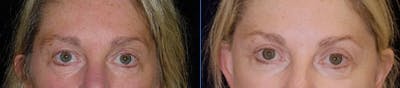 Blepharoplasty Before & After Gallery - Patient 917575 - Image 1