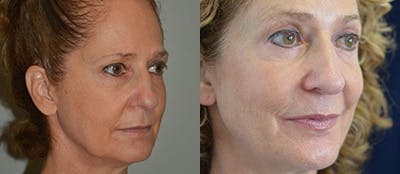 Blepharoplasty Before & After Gallery - Patient 4567078 - Image 1