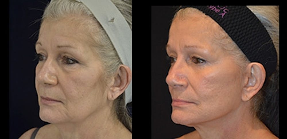 Blepharoplasty Before & After Gallery - Patient 4567080 - Image 1