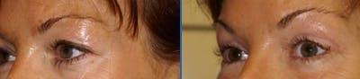 Blepharoplasty Before & After Gallery - Patient 4567081 - Image 1
