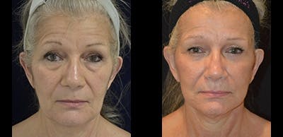 Mini-Facelift Before & After Gallery - Patient 283994 - Image 1