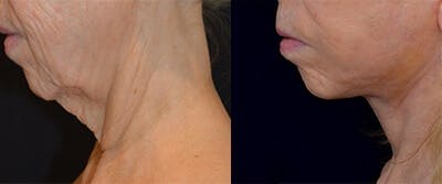 Mini-Facelift Before & After Gallery - Patient 736378 - Image 1