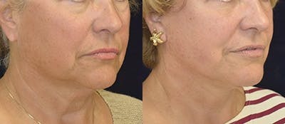 Face Lift Before & After Gallery - Patient 4567087 - Image 1