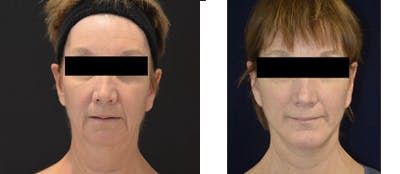 Mini-Facelift Before & After Gallery - Patient 592017 - Image 1