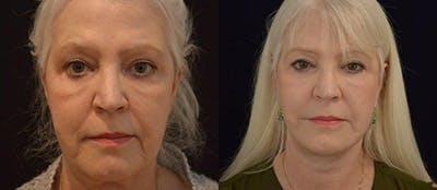 Mini-Facelift Before & After Gallery - Patient 247708 - Image 1