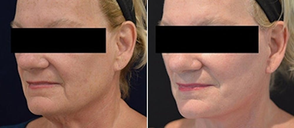 Face Lift Before & After Gallery - Patient 4567092 - Image 1