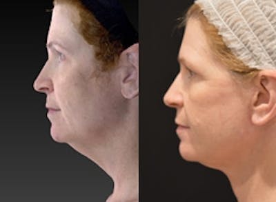 Face Lift Before & After Gallery - Patient 4567093 - Image 1