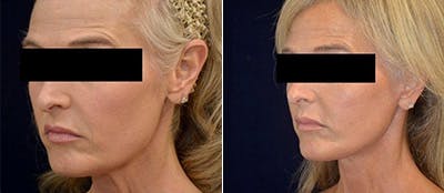Face Lift Before & After Gallery - Patient 4567094 - Image 1