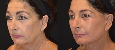 Mini-Facelift Before & After Gallery - Patient 389213 - Image 1