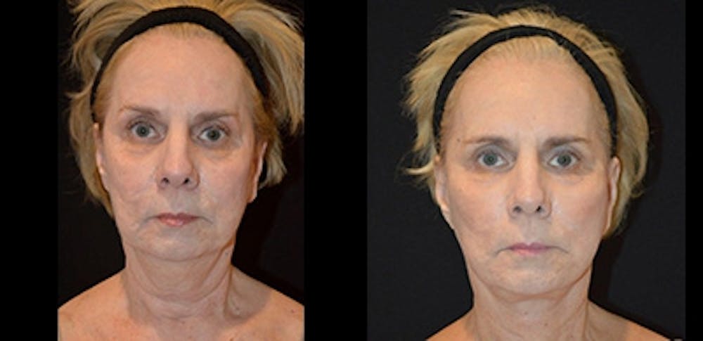 Mini-Facelift Before & After Gallery - Patient 352365 - Image 1