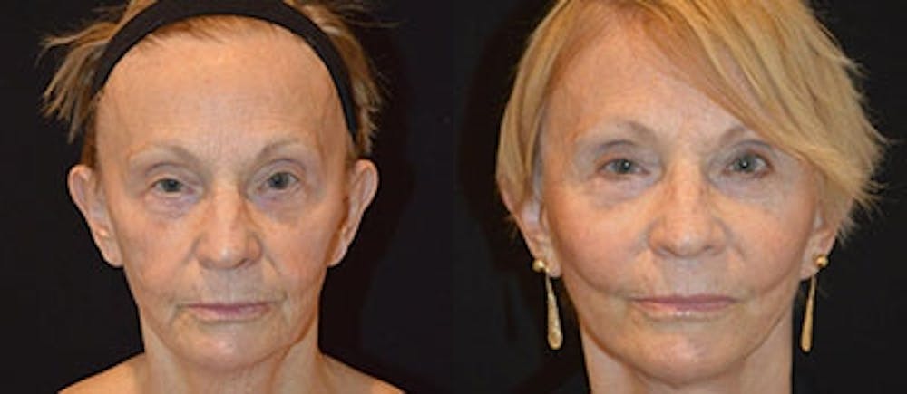 Face Lift Before & After Gallery - Patient 4567097 - Image 1