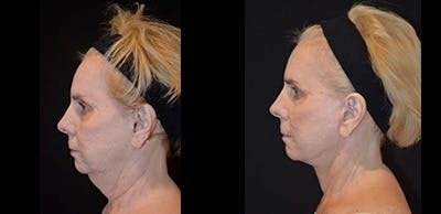 Face Lift Before & After Gallery - Patient 4567098 - Image 1