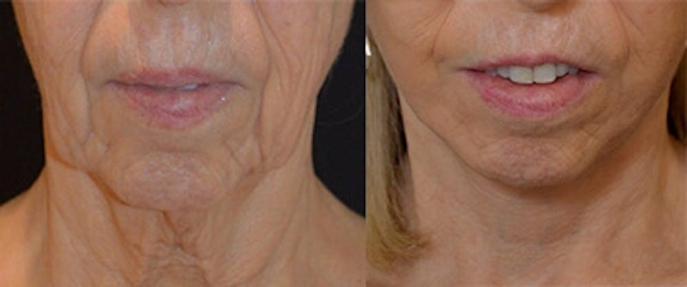 Mini-Facelift Before & After Gallery - Patient 318861 - Image 1