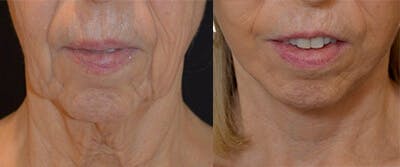 Face Lift Before & After Gallery - Patient 4567099 - Image 1