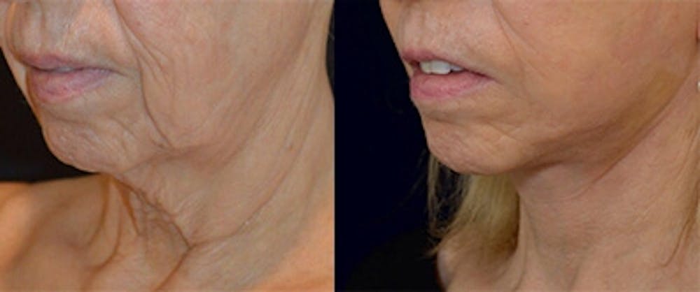 Mini-Facelift Before & After Gallery - Patient 318861 - Image 2